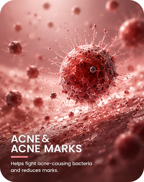 Acne & Acne Marks