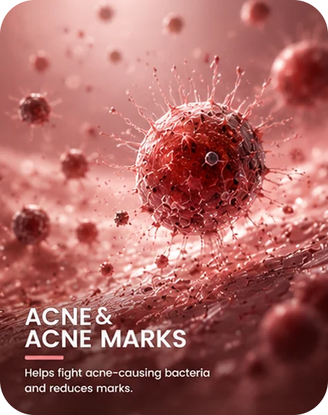 Acne & Acne Marks