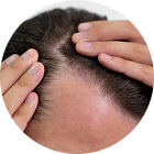 Pattern Hair loss